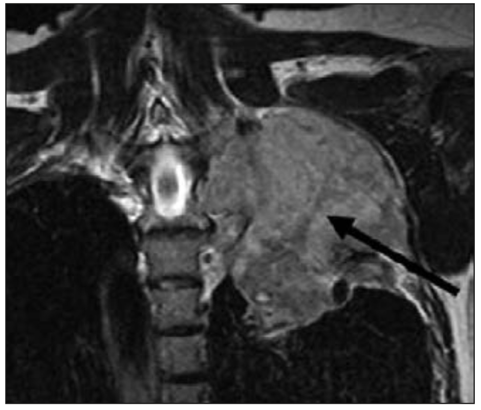 Figura 1. Se observa metástasis costal con lisis tisular, estiramiento del periostio y fractura patológica.