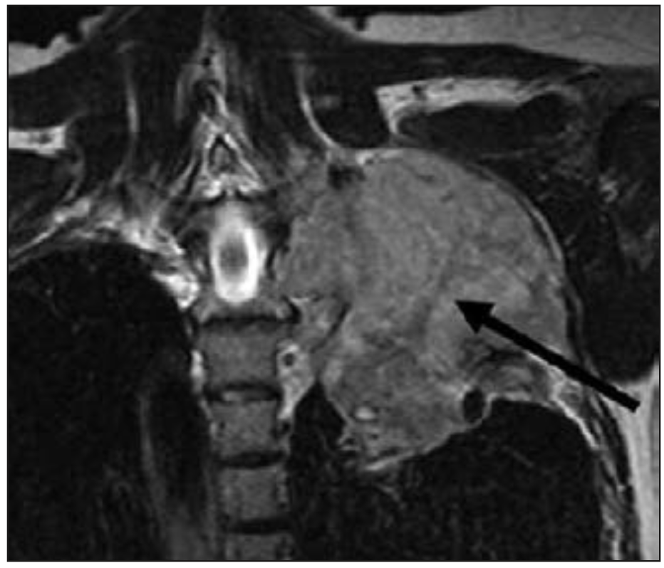 Figura 2. Imagen coronal de RNM T2W muestra tumor en ápex pulmonar izquierdo (Tumor de Pancoast) que invade fosa supraclavicular comprimiendo plexo braquial izquierdo (flecha)(5).