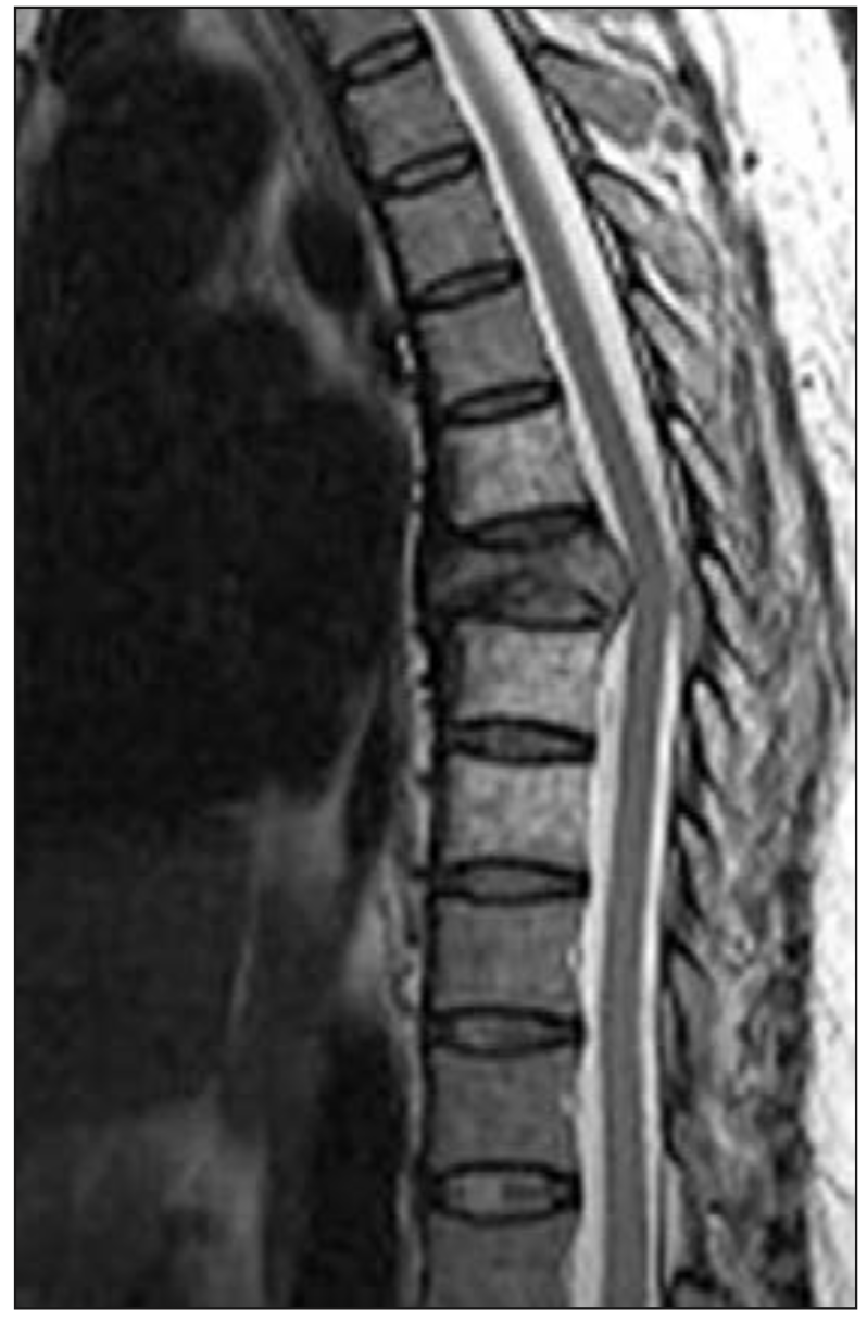  Figura 3. Metástasis ósea a nivel de T7 con compresión medular.