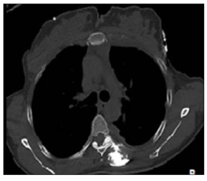 Figura 4. Se observa difusión del medio de contraste hacia el espacio paravertebral, foraminal y epidural (20).