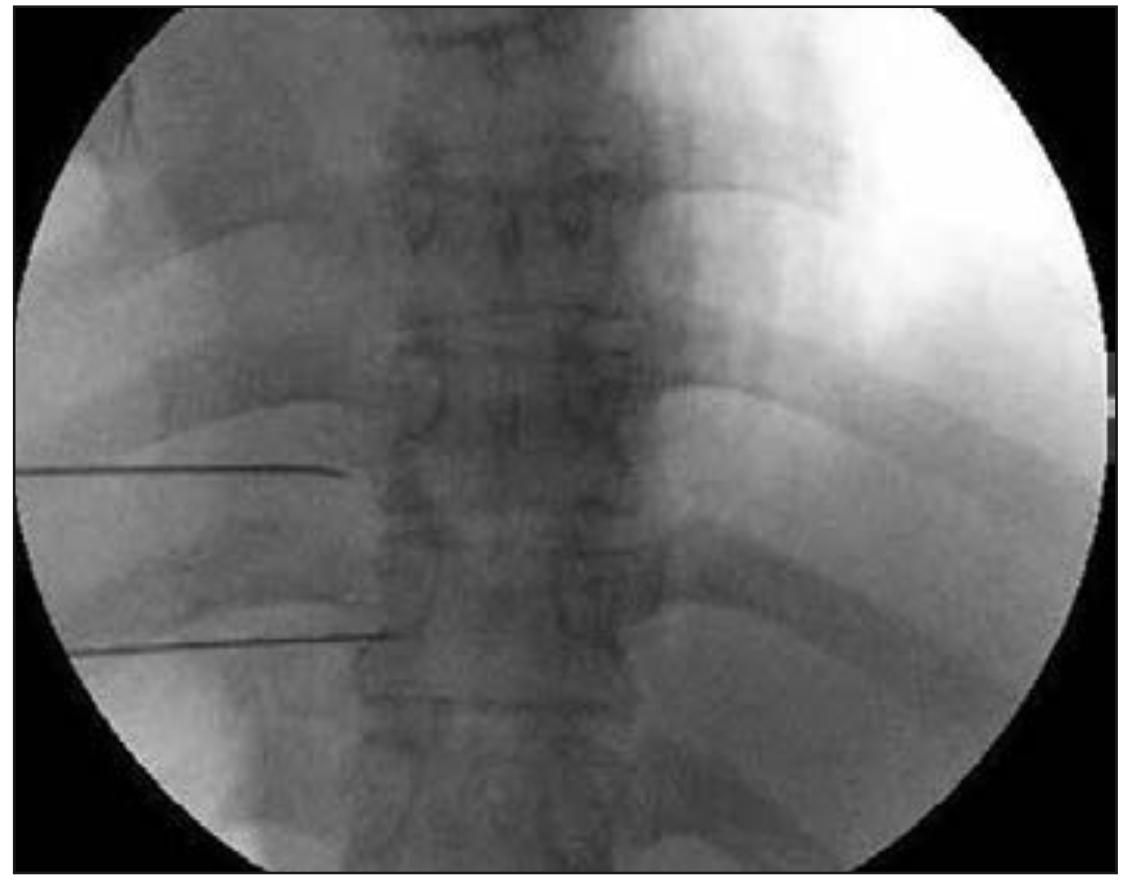 Figura 5. Visión fluoroscópica anteroposterior donde se observan cánulas de radiofrecuencia en espacio paravertebral (21).