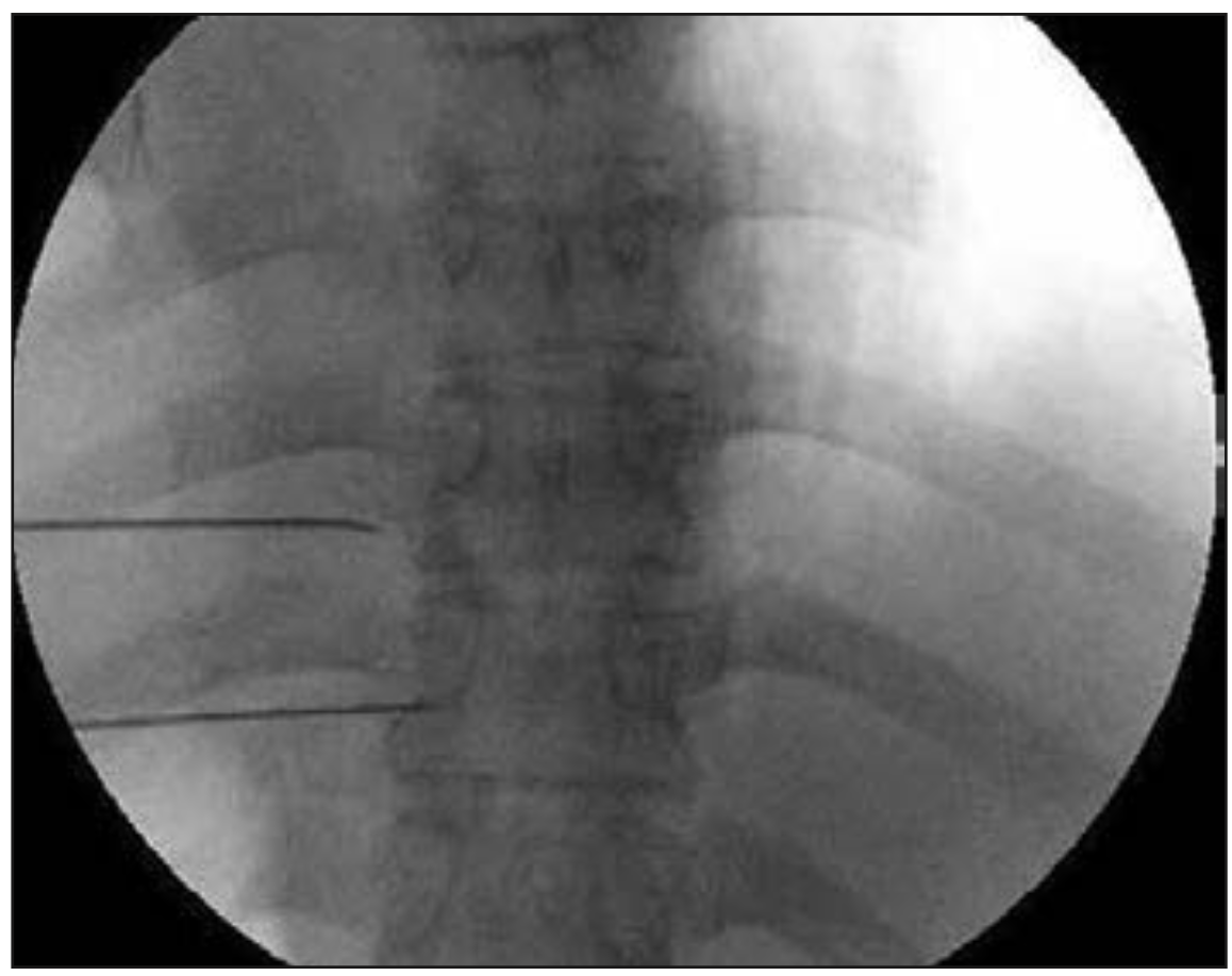 Figura 6. Tumor (asterisco) comprime nervio espinal a nivel de foramen izquierdo a nivel T9 (flecha) (33).