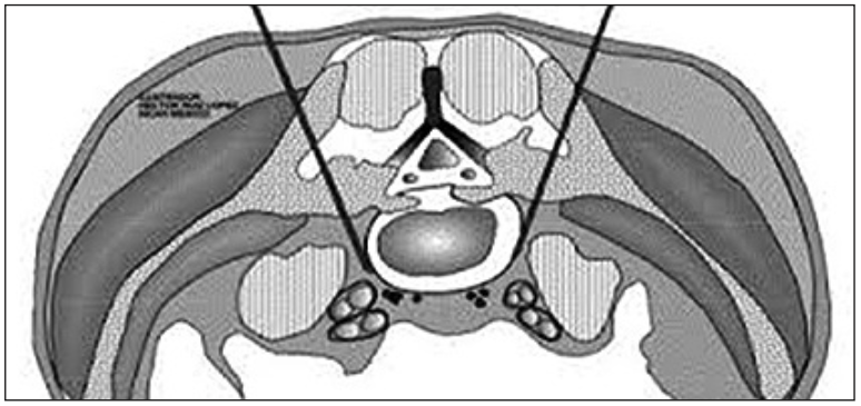 Neurólisis plexo hipogástrico superior Figura 1. Neurólisis plexo hipogástrico superior por vía posterior: se observan agujas que alcanzan borde anterior de L5 (3).