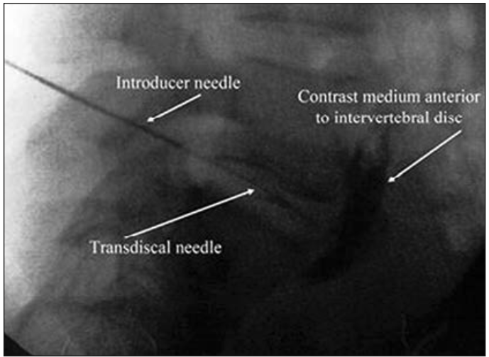 Acceso plexo hipogástrico superior vía transdiscal Figura 2. Acceso plexo hipogástrico superior vía transdiscal: se observa en la figura trayecto transdiscal de la aguja y difusión sobre promontorio sacro del medio de contraste (7).