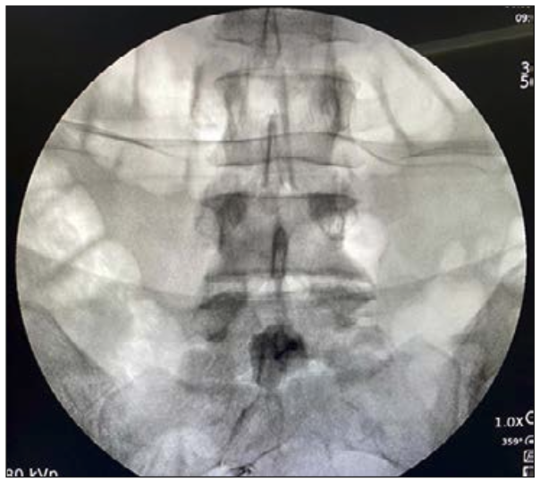 bordaje anterior transabdominal del plexo hipogástrico superior Figura 4: Abordaje anterior transabdominal del plexo hipogástrico superior: se observa difusión del medio de contraste sobre promontorio sacro.