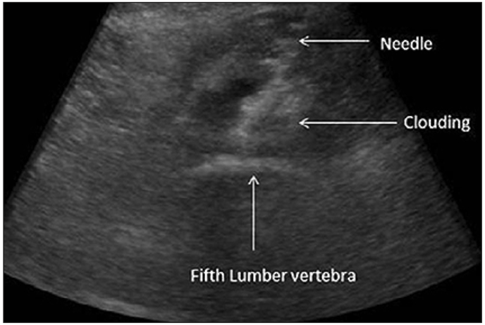 Abordaje anterior transabdominal del plexo hipogástrico superior Figura 5: Abordaje plexo hipogástrico superior vía anterior transabdominal bajo visión ecográfica: se observa trayectoria de aguja que alcanza plano óseo vértebra L5 y la imagen de distribución del líquido que se describe como una nube (14).