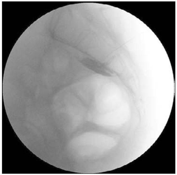 Bloqueo plexo hipogástrico inferior vía trans-sacral Figura 6: Bloqueo plexo hipogástrico inferior vía trans-sacral: se observa aguja a través de foramen S2 y el medio de contraste que difunde a nivel presacro.