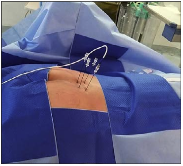 Figura 7: Se observan 4 cánulas de radiofrecuencia en S3 y S4 para realizar rizotomía termal unilateral en S3 y radiofrecuencia pulsada en la S3 contralateral, más rizotomía termal bilateral en S4.