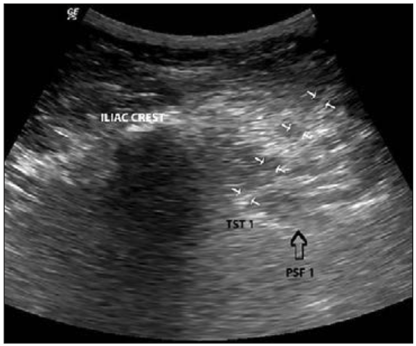 Figura 8: Visión ecográfica muestra cánula (flechas blancas) que alcanza apófisis transversa sacra (TST 1) en borde lateral de foramen sacro S1 (PSF 1).