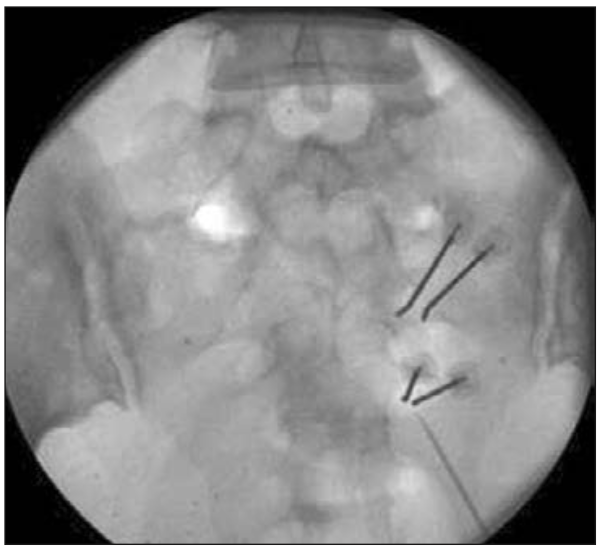 Figura 9: Visión fluoroscópica de cánulas de radiofrecuencia bipolar en S2 y S3.