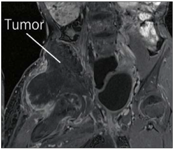 Figura 10: La resonancia magnética muestra que el tumor ilíaco invade el plexo lumbar derecho (65).